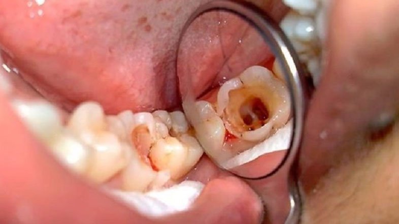 بهترین بیمه برای عصب کشی و درمان ریشه دندان