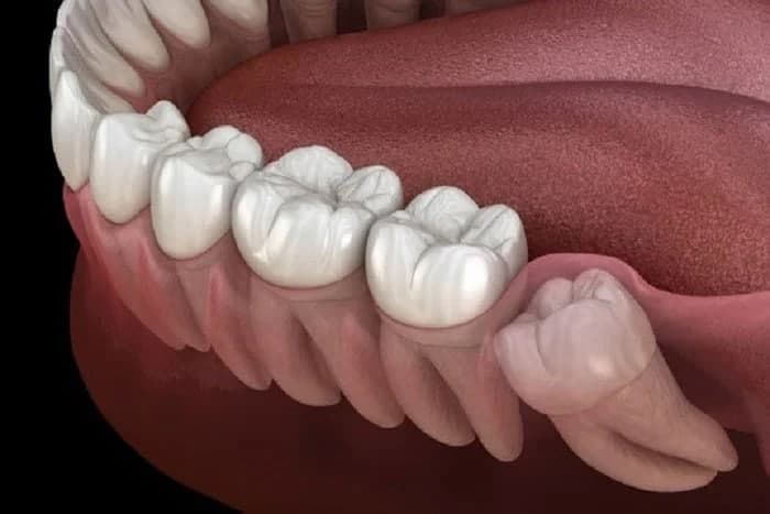 جراحی دندان عقل چقدر طول میکشد خوب شود؟