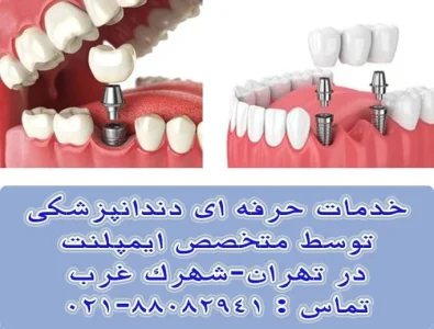 متخصص ایمپلنت کیست و چه ویژگی هایی دارد؟
