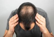 آیا موی طبیعی را بدون جراحی و بیهوشی میتوان کاشت کرد؟