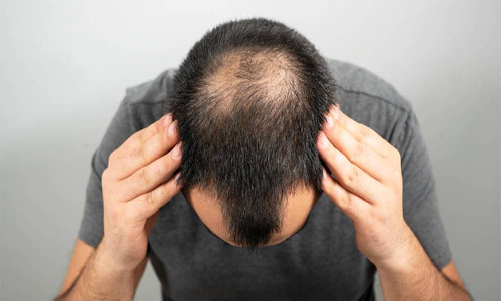 آیا موی طبیعی را بدون جراحی و بیهوشی میتوان کاشت کرد؟
