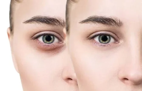 ی کرم دور چشم خوب نی نی سایت