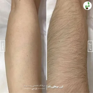 رفع موهای زائد با پوست گردو