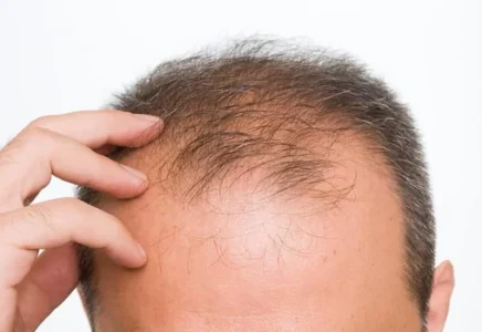 کاشت مو بدون بانک مو چگونه است