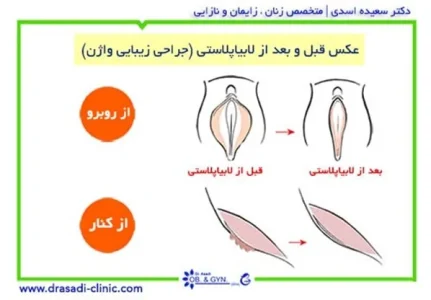 آشنایی با انواع عمل جراحی زنان توسط دکتر اسدی بهترین متخصص زنان در تهران