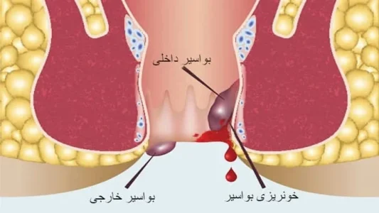 برای قطع خونریزی بواسیر چه باید کرد برای قطع خونریزی بواسیر چه باید کرد