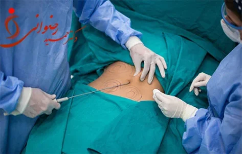 مرگ بر اثر ابدومینوپلاستی
