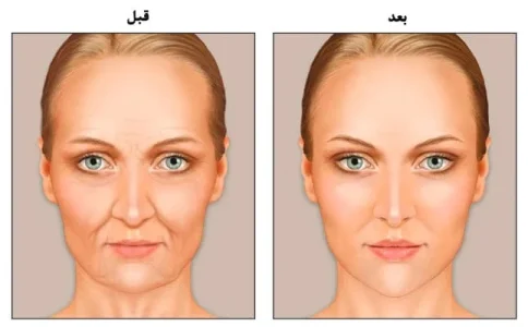 تزریق ژل برای چاقی صورت