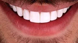 قیمت هر روکش لمینت دندان برای هر دندان
