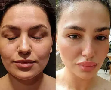 ماندگاری تزریق چربی به صورت لاغر
