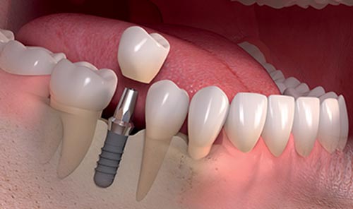 قبل، حین و بعد از جراحی ایمپلنت دندان چه اتفاقی می افتد؟