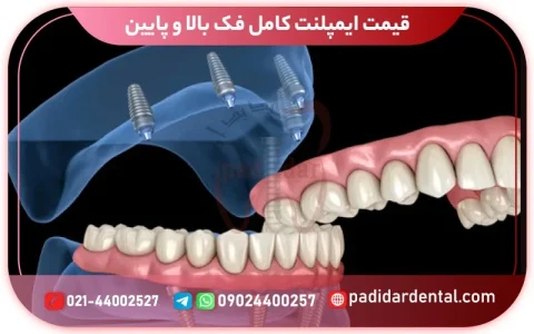 قیمت ایمپلنت کامل فک بالا و پایین: هر آنچه باید بدانید