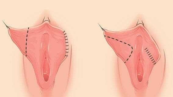 عوارض عمل لابیاپلاستی چیست؟