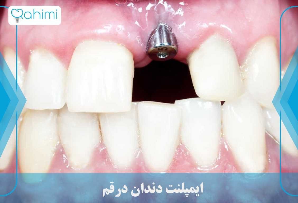 متخصص کشیدن دندان در قم – مراقبت تخصصی از سوی دکتر رحیمی