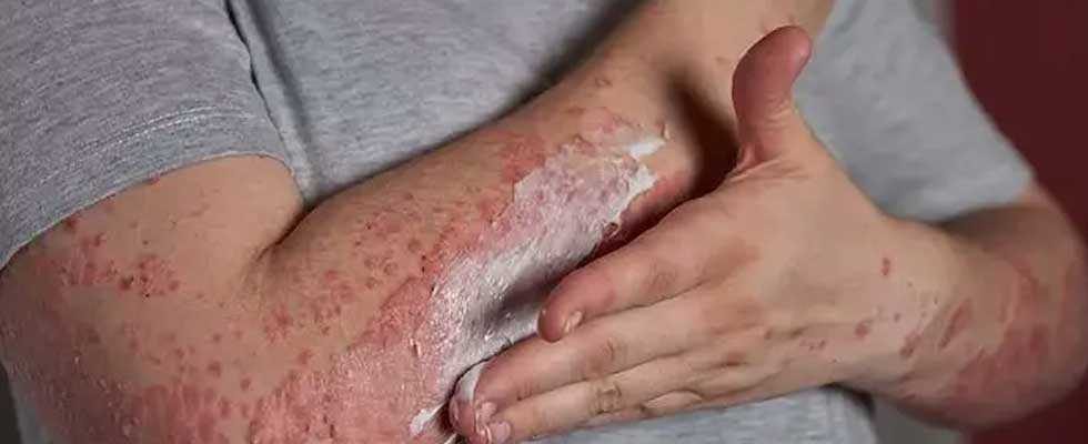 بهترین پماد برای درمان اگزمای پوستی: بررسی تخصصی و مقایسه برندها
