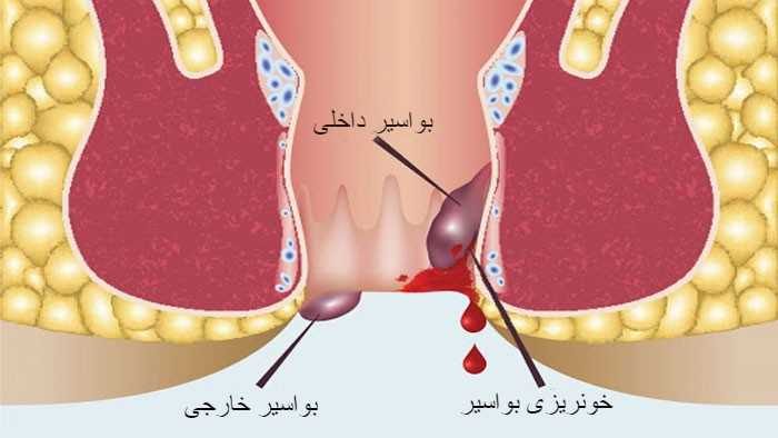 برای قطع خونریزی بواسیر چه باید کرد
