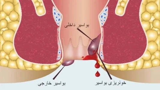 برای قطع خونریزی بواسیر چه باید کرد