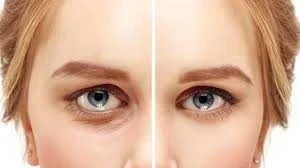 بلفاروپلاستی بدون جراحی چیست؟ بلفاروپلاستی بدون جراحی چیست؟