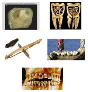 عصب کشی دندان در زمان قدیم چگونه انجام می شد؟