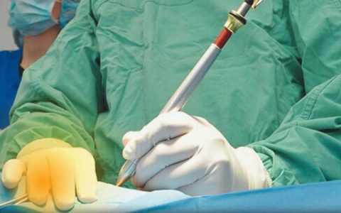 لیزر شقاق مقعدی توسط دکتر نجاری