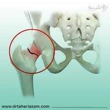 شکستگی لگن چه مدت خوب می شود؟ شکستگی لگن چه مدت خوب می شود؟