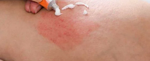 بهترین پماد برای درمان اگزمای پوستی: بررسی تخصصی و مقایسه برندها