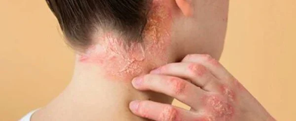 بهترین پماد برای درمان اگزمای پوستی: بررسی تخصصی و مقایسه برندها